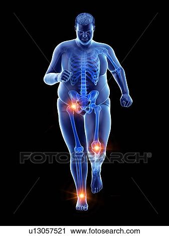 Stock Image - Obese runner with joint pain, computer illustration.. Fotosearch