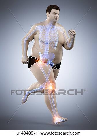 Stock Image - Obese runner with joint pain, computer illustration.. Fotosearch