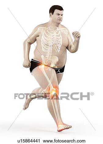 Stock Image - Obese runner with joint pain, computer illustration.. Fotosearch