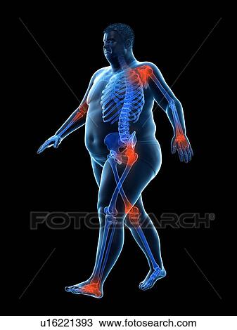 Stock Image - Obese runner with joint pain, computer illustration.. Fotosearch
