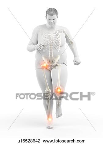 Obese runner with joint pain, computer illustration. View Large Photo Image Stock Image - Obese runner with joint pain, computer illustration.. Fotosearch