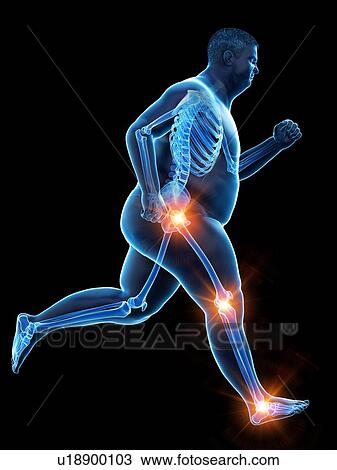 Stock Image - Obese runner with joint pain, computer illustration.. Fotosearch