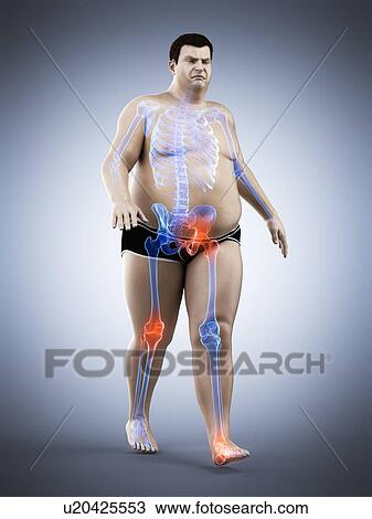 Stock Image - Obese runner with joint pain, computer illustration.. Fotosearch