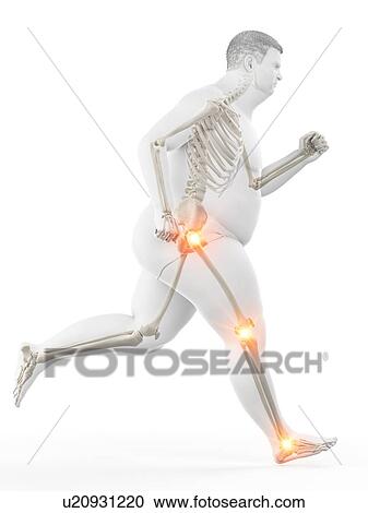 Stock Image - Obese runner with joint pain, computer illustration.. Fotosearch