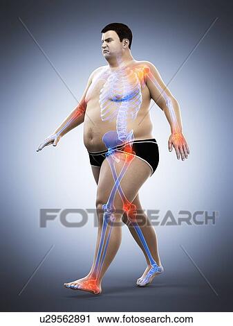 Obese runner with joint pain, computer illustration. View Large Photo Image Stock Image - Obese runner with joint pain, computer illustration.. Fotosearch