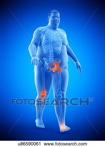 Stock Image - Obese runner with joint pain, computer illustration.. Fotosearch