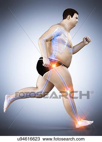 Stock Image - Obese runner with joint pain, computer illustration.. Fotosearch