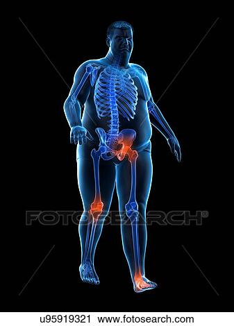 Stock Image - Obese runner with joint pain, computer illustration.. Fotosearch