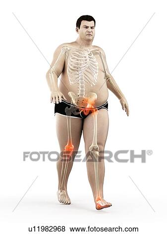 Obese runner with joint pain, computer illustration. View Large Photo Image Stock Photo - Obese runner with joint pain, computer illustration.. Fotosearch