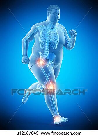 Stock Photo - Obese runner with joint pain, computer illustration.. Fotosearch