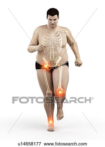 Obese runner with joint pain, computer illustration. View Large Photo Image Stock Photo - Obese runner with joint pain, computer illustration.. Fotosearch