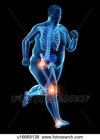 Stock Photo - Obese runner with joint pain, computer illustration.. Fotosearch