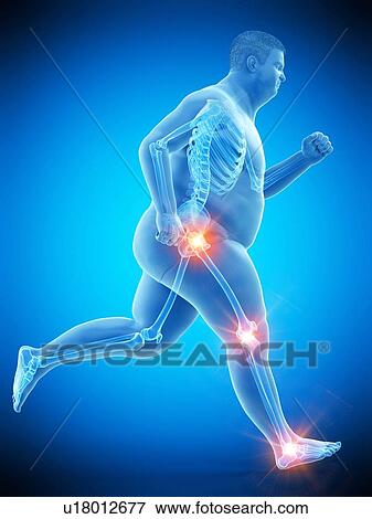 Stock Photo - Obese runner with joint pain, computer illustration.. Fotosearch