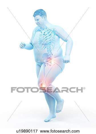 Stock Photo - Obese runner with joint pain, computer illustration.. Fotosearch