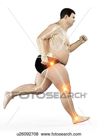 Stock Photo - Obese runner with joint pain, computer illustration.. Fotosearch