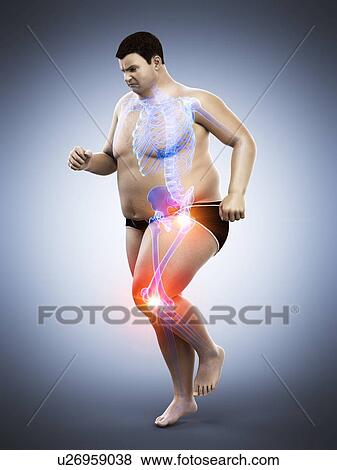 Stock Photo - Obese runner with joint pain, computer illustration.. Fotosearch