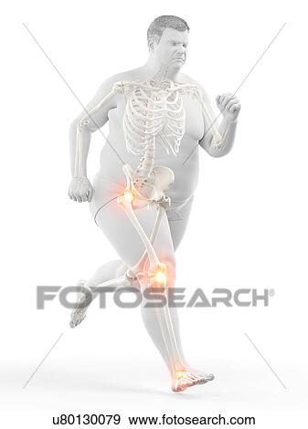 Stock Photo - Obese runner with joint pain, computer illustration.. Fotosearch
