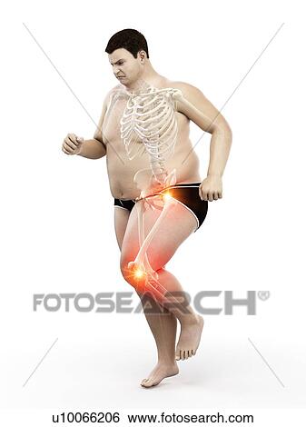 Stock Photograph - Obese runner with joint pain, computer illustration.. Fotosearch