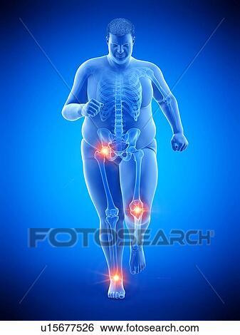 Obese runner with joint pain, computer illustration. View Large Photo Image Stock Photograph - Obese runner with joint pain, computer illustration.. Fotosearch