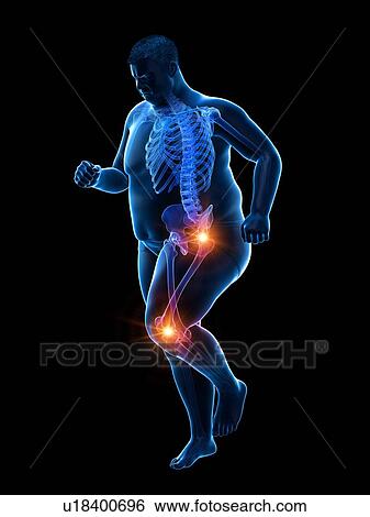 Stock Photograph - Obese runner with joint pain, computer illustration.. Fotosearch
