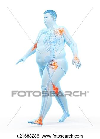 Stock Photograph - Obese runner with joint pain, computer illustration.. Fotosearch