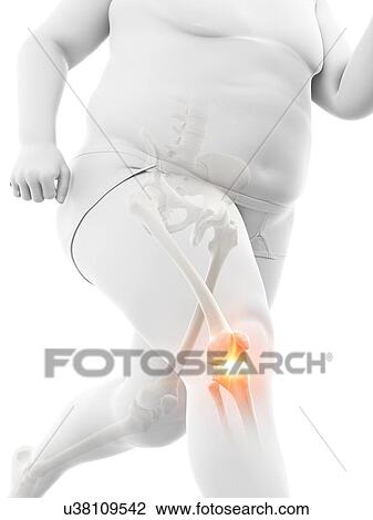 Stock Image - Obese runner with knee pain, computer illustration.. Fotosearch