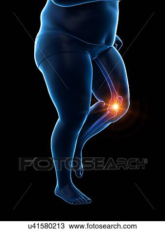 Stock Image - Obese runner with knee pain, computer illustration.. Fotosearch