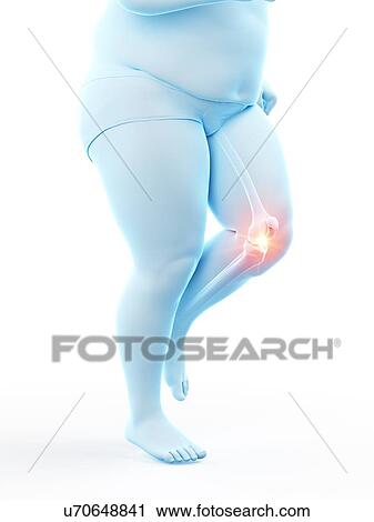 Stock Image - Obese runner with knee pain, computer illustration.. Fotosearch