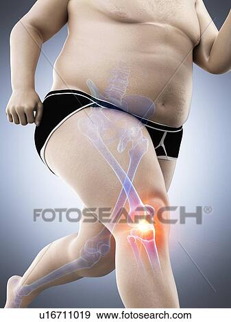 Obese runner with knee pain, computer illustration. View Large Photo Image Stock Photo - Obese runner with knee pain, computer illustration.. Fotosearch
