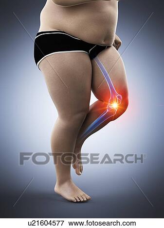 Stock Photo - Obese runner with knee pain, computer illustration.. Fotosearch