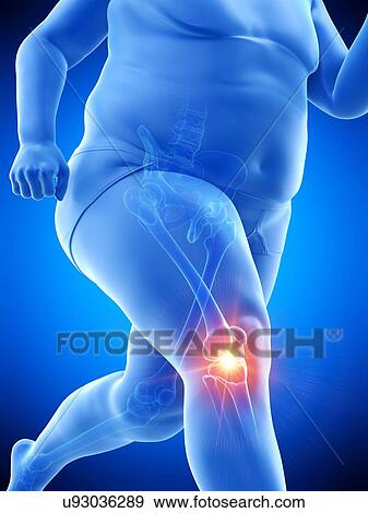 Obese runner with knee pain, computer illustration. View Large Photo Image Stock Photo - Obese runner with knee pain, computer illustration.. Fotosearch