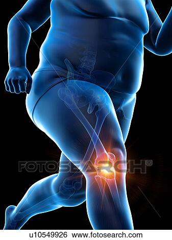 Stock Photograph - Obese runner with knee pain, computer illustration.. Fotosearch