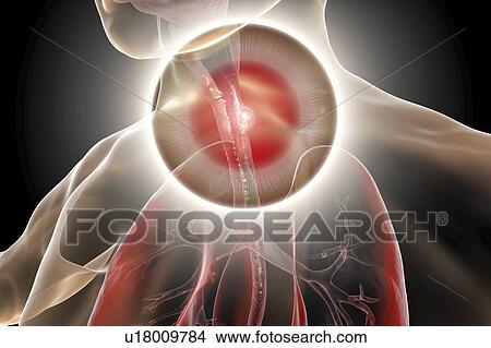 Picture - Oesophageal cancer, computer illustration.. Fotosearch