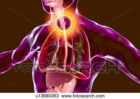 Oesophageal cancer, computer illustration. View Large Photo Image Stock Image - Oesophageal cancer, computer illustration.. Fotosearch