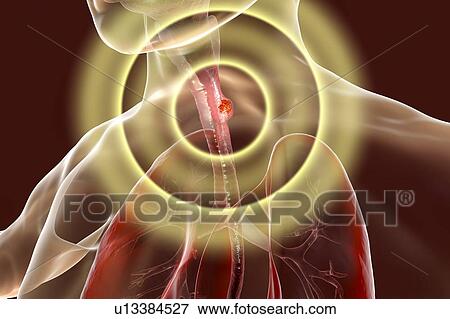 Oesophageal cancer, computer illustration. View Large Photo Image Stock Photo - Oesophageal cancer, computer illustration.. Fotosearch