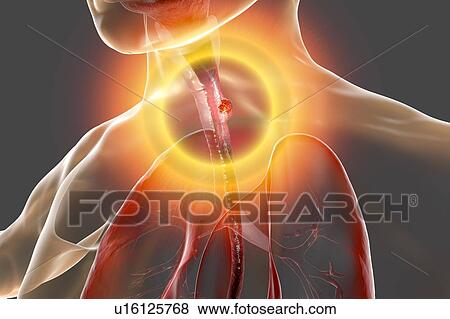 Stock Photo - Oesophageal cancer, computer illustration.. Fotosearch