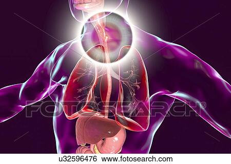 Oesophageal cancer, computer illustration. View Large Photo Image Stock Photograph - Oesophageal cancer, computer illustration.. Fotosearch