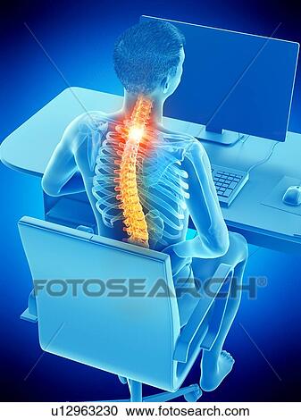 Stock Image - Office worker with back pain, conceptual illustration.. Fotosearch