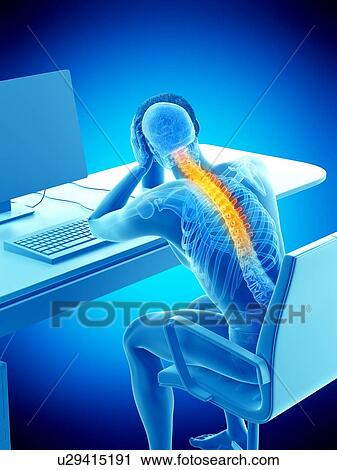 Stock Image - Office worker with back pain, conceptual illustration.. Fotosearch