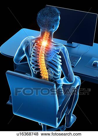 Stock Photo - Office worker with back pain, conceptual illustration.. Fotosearch