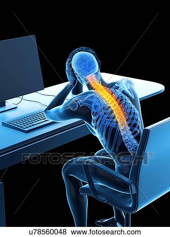 Stock Photo - Office worker with back pain, conceptual illustration.. Fotosearch