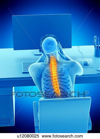 Stock Photography - Office worker with back pain, conceptual illustration.. Fotosearch