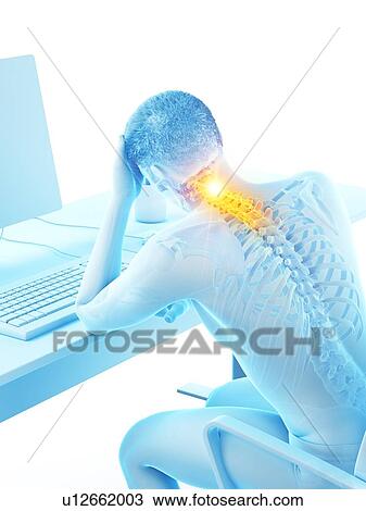 Stock Image - Office worker with neck pain, conceptual illustration.. Fotosearch