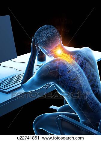 Stock Image - Office worker with neck pain, conceptual illustration.. Fotosearch