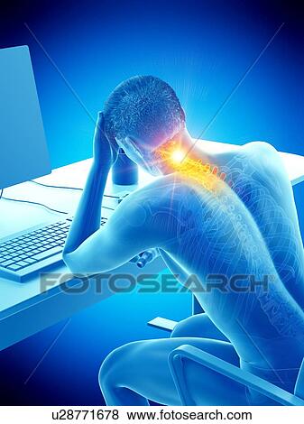 Stock Photo - Office worker with neck pain, conceptual illustration.. Fotosearch