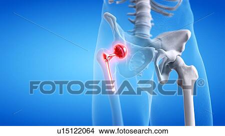 Painful hip replacement, conceptual illustration View Large Photo Image Picture - Painful hip replacement, conceptual illustration. Fotosearch