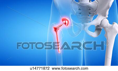 Stock Image - Painful hip replacement, conceptual illustration. Fotosearch