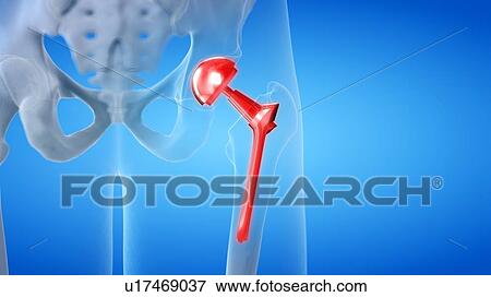 Stock Photo - Painful hip replacement, conceptual illustration. Fotosearch