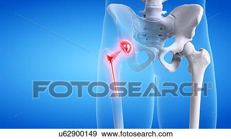 Painful hip replacement, conceptual illustration View Large Photo Image Stock Photo - Painful hip replacement, conceptual illustration. Fotosearch
