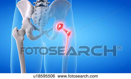 Stock Photograph - Painful hip replacement, conceptual illustration. Fotosearch